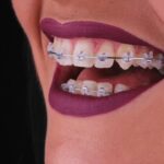 Koliko dugo se nosi fiksna proteza