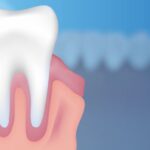 Upala desni kod dece